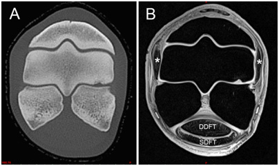 Fig 02. CT scans result in excellent bone but poor soft tissue discrimination while MR gives the opposite; poor bone architecture but good soft tissue differentiation. A CT image of the fetlock joint region (A) shows the third metacarpal, proximal phalanx and the proximal sesamoid bones but little soft tissue. The MR image (B) resolves no bone detail but clearly shows the deep digital flexor (DDFT) and superficial digital flexor (SDFT) tendons as well as the collateral ligaments of the fetlock joint (asterisks).